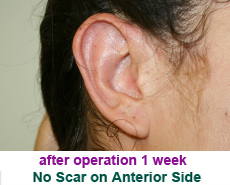 plastic-surgery-prominent-ear 